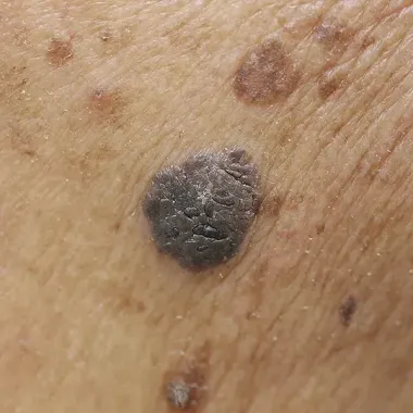 Карцинозинум