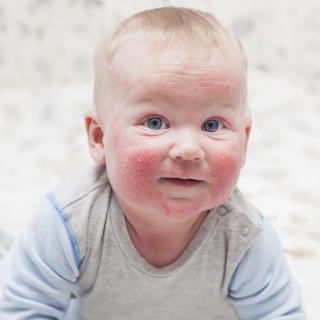 диатез ребёнок